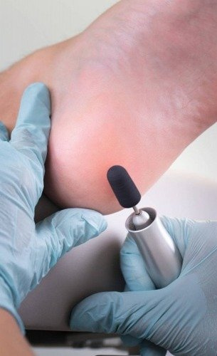 RUCK® jednorazowe kapturki MedCap do pedicure, Ø 5 mm / ziarn. 60 (1 szt.).