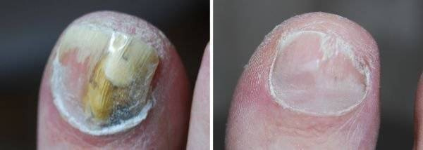Fotodynamiczna terapia PACT® MED przeciw grzybicy paznokci