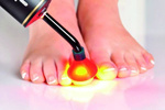Fotodynamiczna terapia PACT® MED przeciw grzybicy paznokci